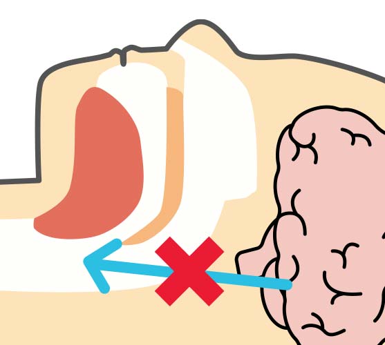 中枢性睡眠時無呼吸症候群（CSAS）