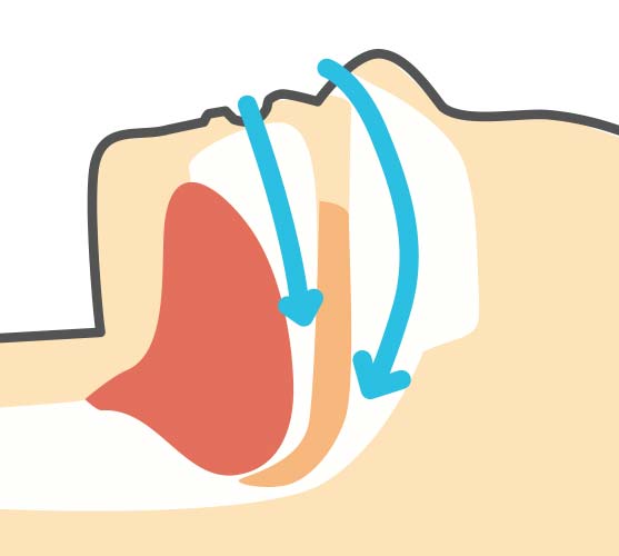 閉塞性睡眠時無呼吸症候群（OSAS）